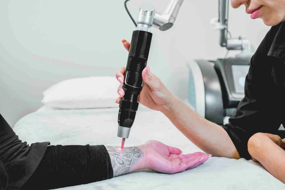 Laser tattoo removal treatment
