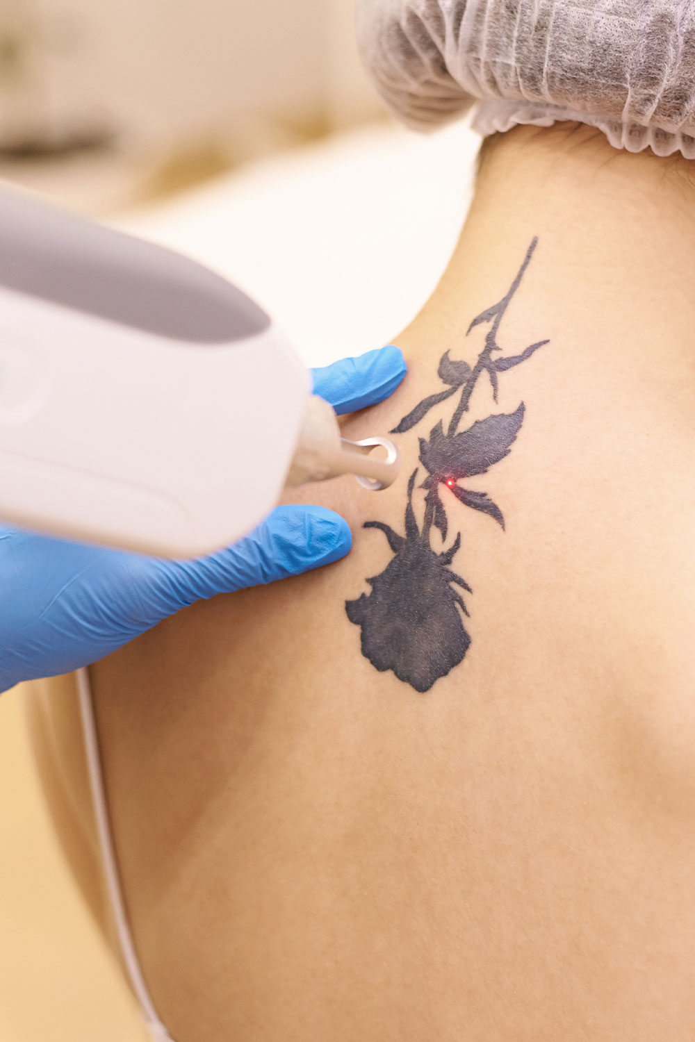 Laser TattooRemoval Sessions  Gammons Medical  Groupon