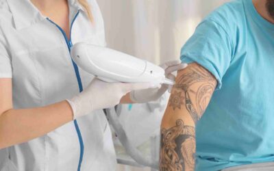 What is the Best Tattoo Removal Laser?