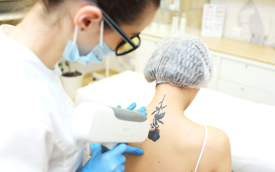 How Much is Tattoo Removal?